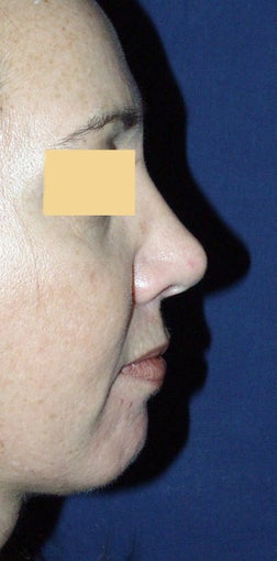 Chin Augmentation