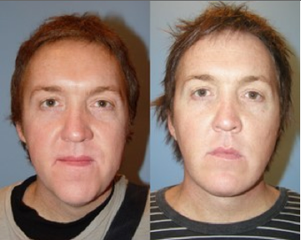 Chin Augmentation