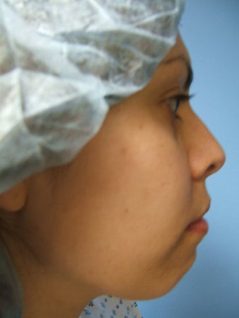 Chin Augmentation