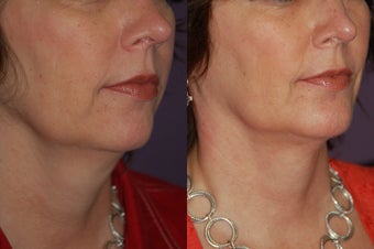 Chin implant