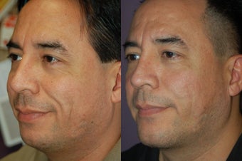 chin implant