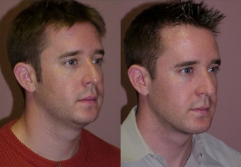 Chin Augmentation With Submental Liposuction
