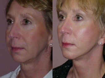Chin Implant