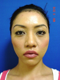 Chin Augmentation/rhinoplasty