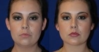 Liposuction of neck with chin implant