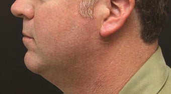 Chin Implant and Laser-Assisted Lipocontouring of Neck