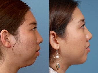 Chin Augmentation