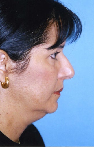 Chin Implant
