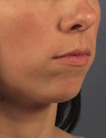 Chin Implant