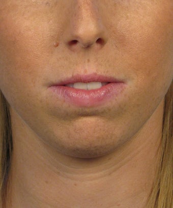 Chin Implant
