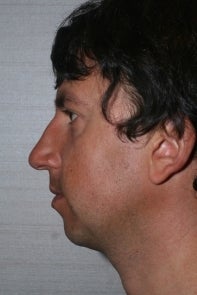 Chin Implant