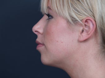 Chin Implant