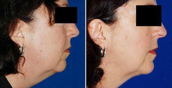 Chin Implant