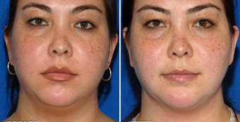 Chin Implant