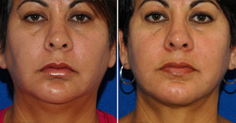 Chin Implant