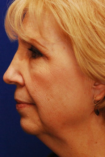 Chin Implant