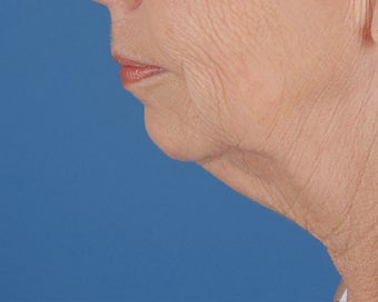 Chin Implant