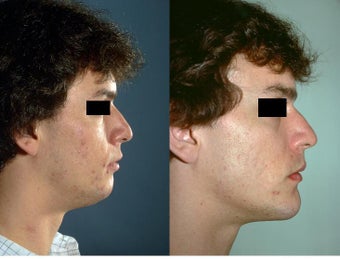 Chin Implant surgery