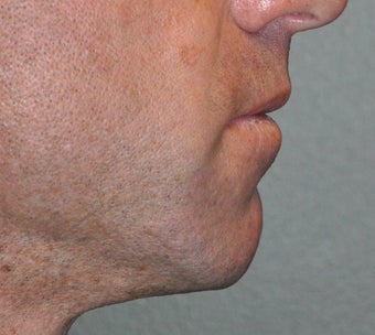 Chin Augmentation