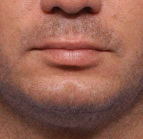 Chin Augmentation