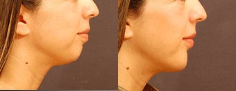 Chin Implant Surgery