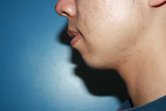 Chin augmentation