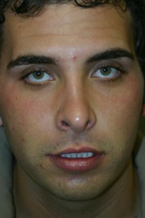 Chin Implant