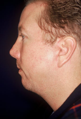 Chin Implant