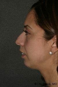 Chin Augmentation 
