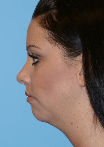 Chin Implant