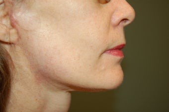 Malouf Mini-lift