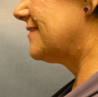 chin liposuction