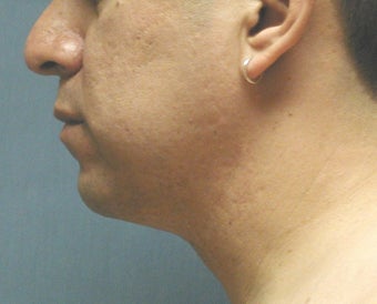 chin liposuction