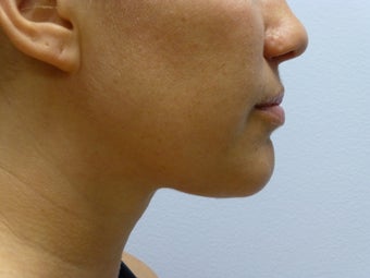 Liposuction to chin/neck area