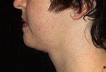 Chin Liposuction