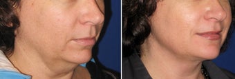Chin / Neck Liposuction