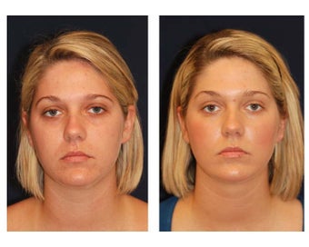 Chin Lipo