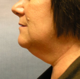 chin liposuction