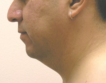 chin liposuction