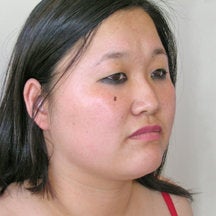 Chin Liposuction 