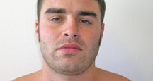 Chin Liposuction 