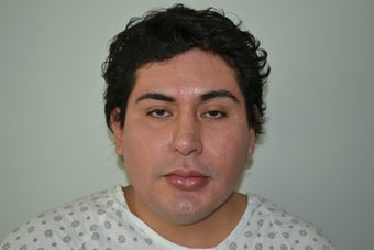 Submental Chin Liposuction
