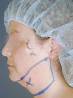 Chin Liposuction