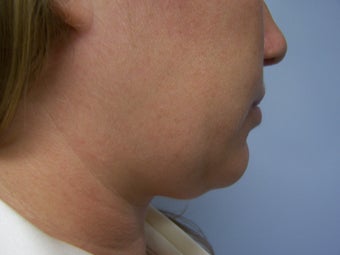 Liposuction to chin/neck area