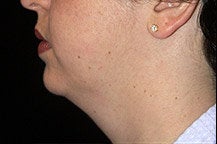 Chin Liposuction