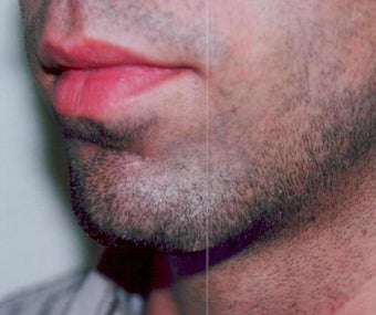 Chin augmentation using prosthesis
