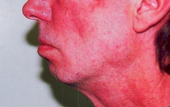 Chin Augmentation