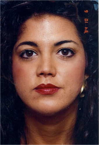 septoplasty, cleft lip repair