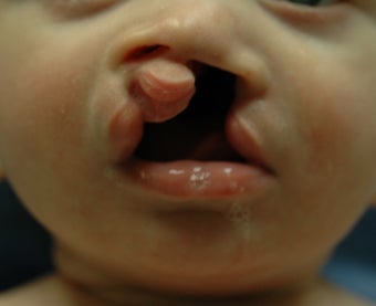 Cleft lip and palate