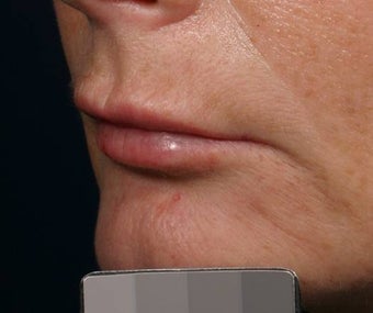 Filler